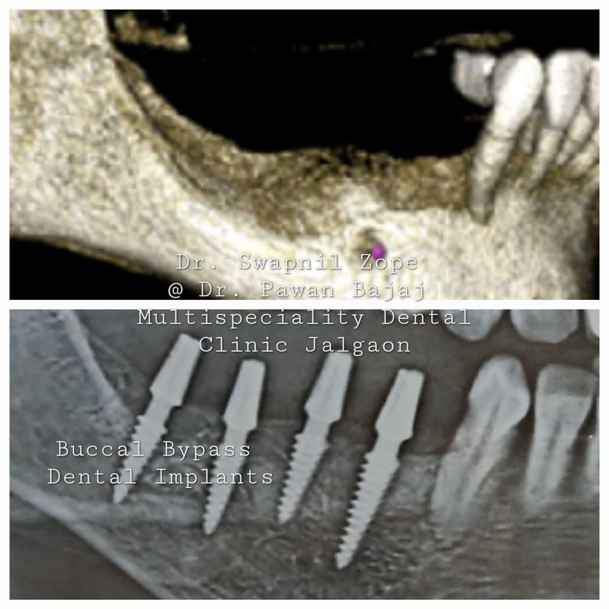 'Bypassing the Ordinary: Buccal Implants for a Grin-Worthy Smile!' 

#BasalImplants
#CompressiveImplants
#DentalSurgery
#PermanentTeeth
#Implantology
#OralHealth
#SmileRestoration
#DentalInnovation
#AdvancedImplants
#OralRehabilitation
