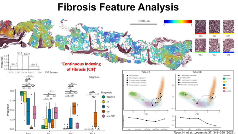 MPN_Hub's tweet photo. CONGRESS | #IACH23 | #MPNCo&D
Daniel Royston @DJ_Royston @RDMOxford @UniofOxford discusses how deep learning approaches can identify key cytological and morphological features in BM biopsies, and cohort indexing of megakaryocytes. Shows morphological findings from a phII trial of zinpentraxin alfa in MF highlighting moderate correlation between manual grading vs quantitative evaluation of fibrosis, and fibrosis heterogeneity. Advises need for validation and regulatory approval before real world clinical application.
@TheIACH #MPNCo&D #IACH2023 #MPN​ #MPNsm​ #myelofibrosis