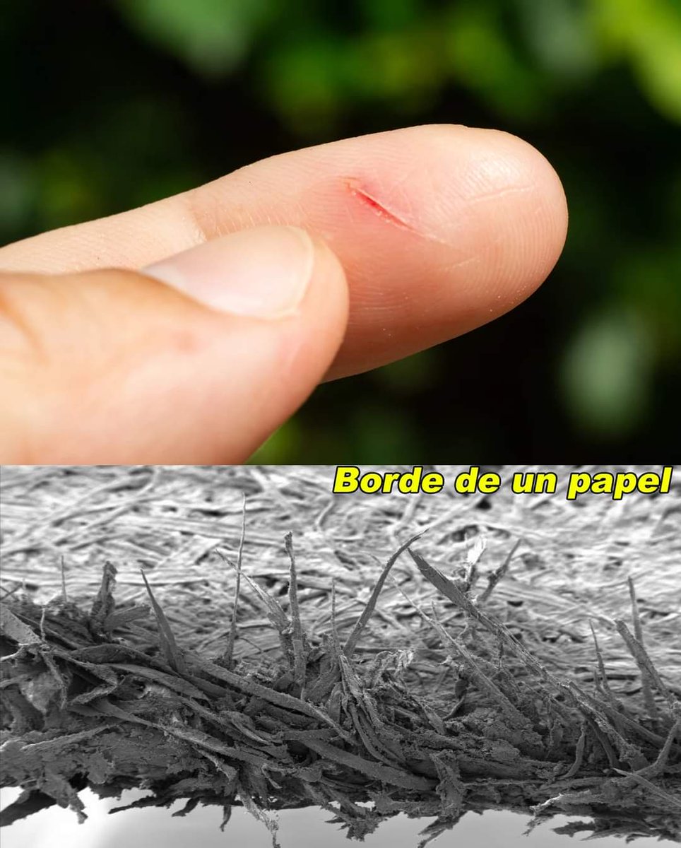 InformaCosmos's tweet photo. ¿Por qué los cortes con papel duelen mucho?

Los bordes de las hojas de papel, a simple vista, parecen rectos. Sin embargo, a nivel microscópico, son aserrados. 

Estos bordes desgarran la piel al cortar, afectando más terminaciones nerviosas. Esto causa un dolor más intenso al compararse con otros cortes. 

Las partículas minúsculas del papel pueden quedarse en la herida. Estas fibras pueden irritar el tejido, incrementando el malestar. 

Los gilet o bisturís, gracias a su diseño afilado, generan cortes limpios. Aunque estos cortes son más profundos, tienden a ser menos dolorosos.