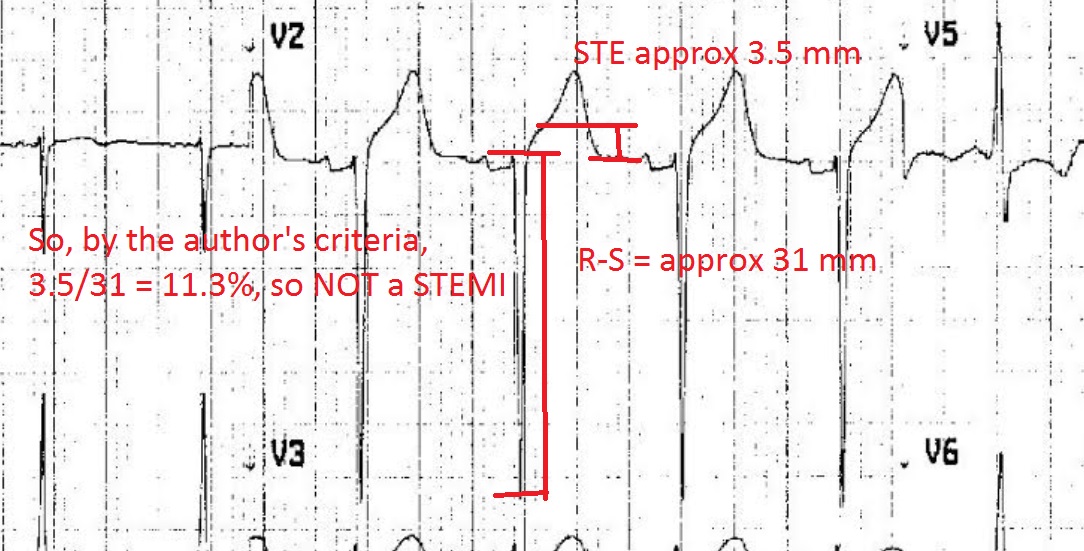 I usually follow this; MI vs LVH