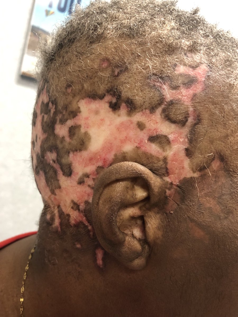 Janetbirdope's tweet photo. #RashWeek #Diagnosis in 1 picture. hint #SLE #Lupus #ClinicalPearl #MedX #MedEd https://t.co/jrGAIFkd95