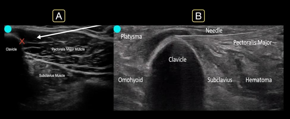 New Nerve Block from Highland US team! The Clavipectoral Plane Block (CPB) is a quick, safe, and efficient way of controlling pain from clavicular fractures. See our case series to help improve pain control and dispos from your department. @NagdevArun @HenryCAshworth