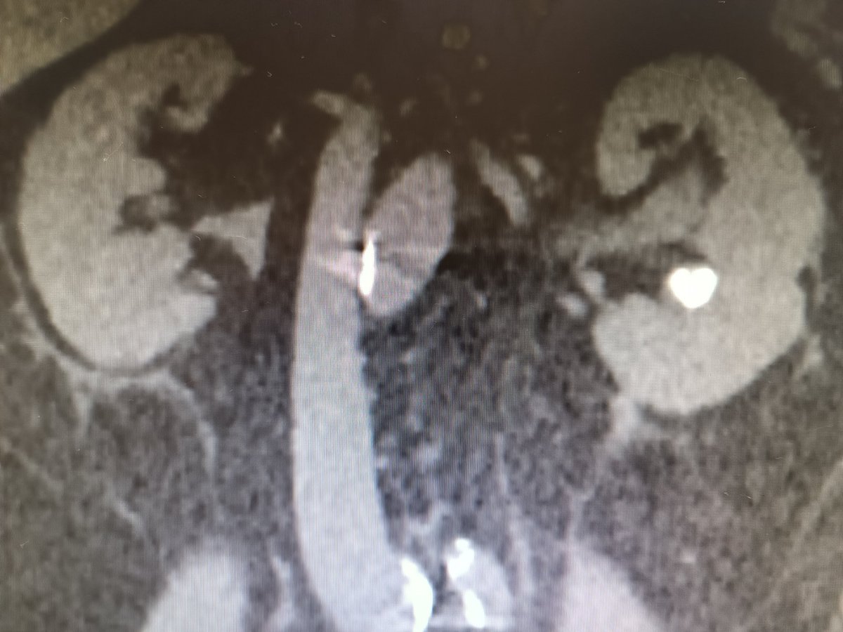 Litiasis coraciforme #Urología #litiasis