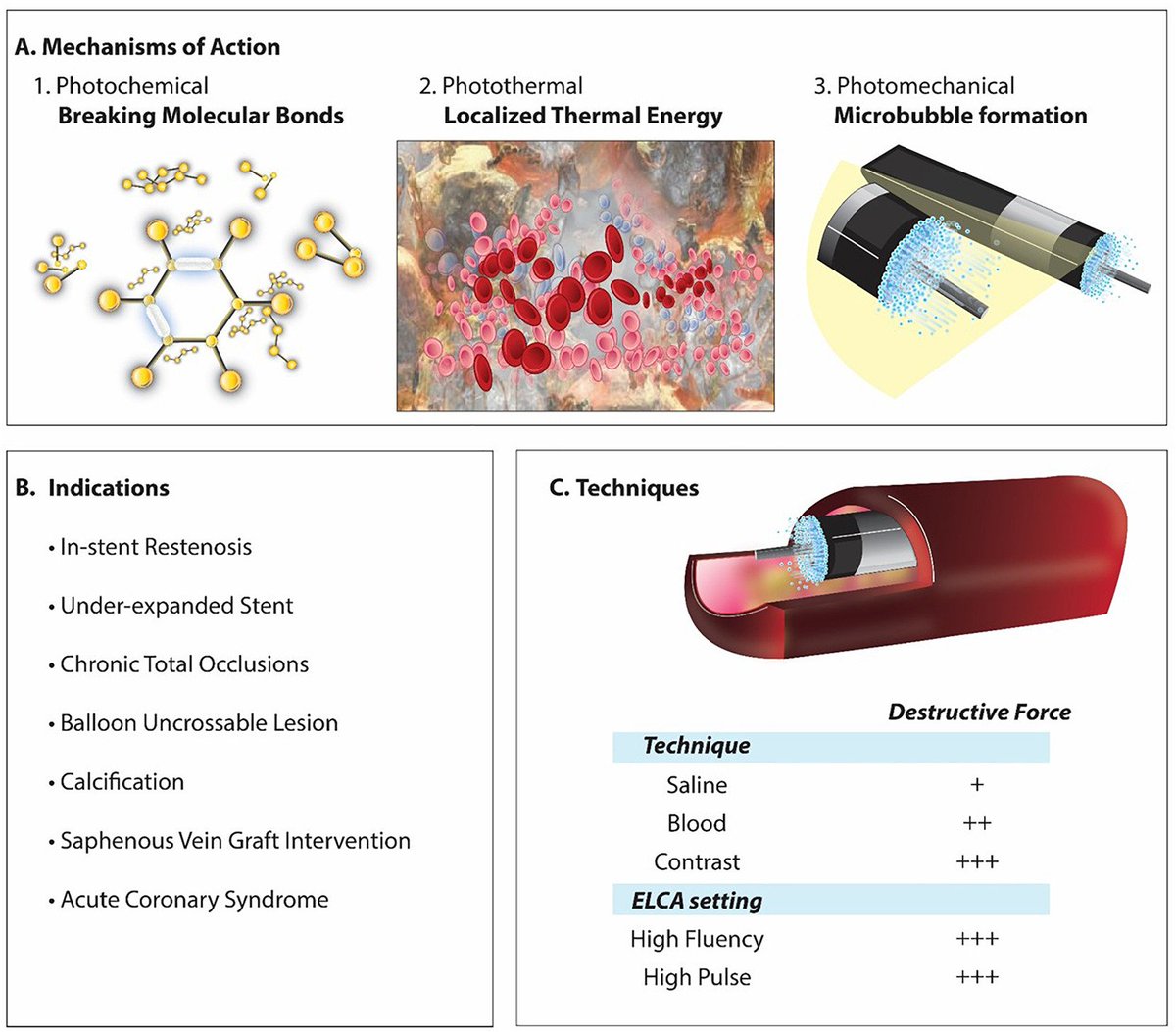 CRMjournal's tweet image. Congratulations to @rstsutsui et al. on their highly cited publication in #CRM in 2023 which for a LIMITED TIME is OPEN ACCESS!!!

Excimer Laser Atherectomy #ELCA in #PCI: A Contemporary Review

sciencedirect.com/science/articl…