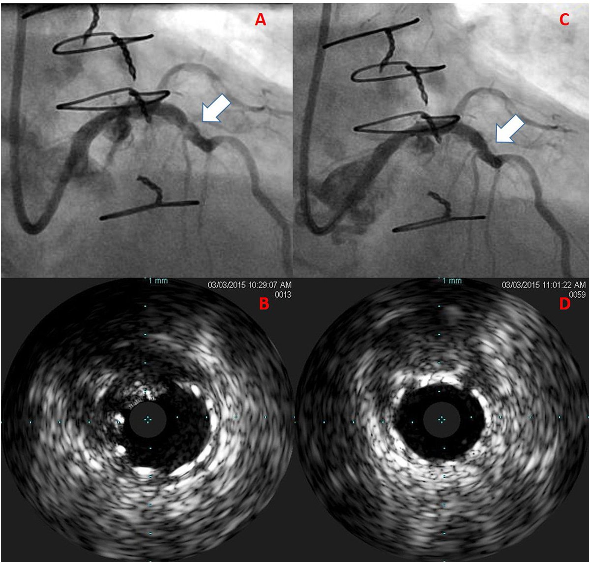 CRMjournal's tweet image. Congratulations to @rstsutsui et al. on their highly cited publication in #CRM in 2023 which for a LIMITED TIME is OPEN ACCESS!!!

Excimer Laser Atherectomy #ELCA in #PCI: A Contemporary Review

sciencedirect.com/science/articl…
