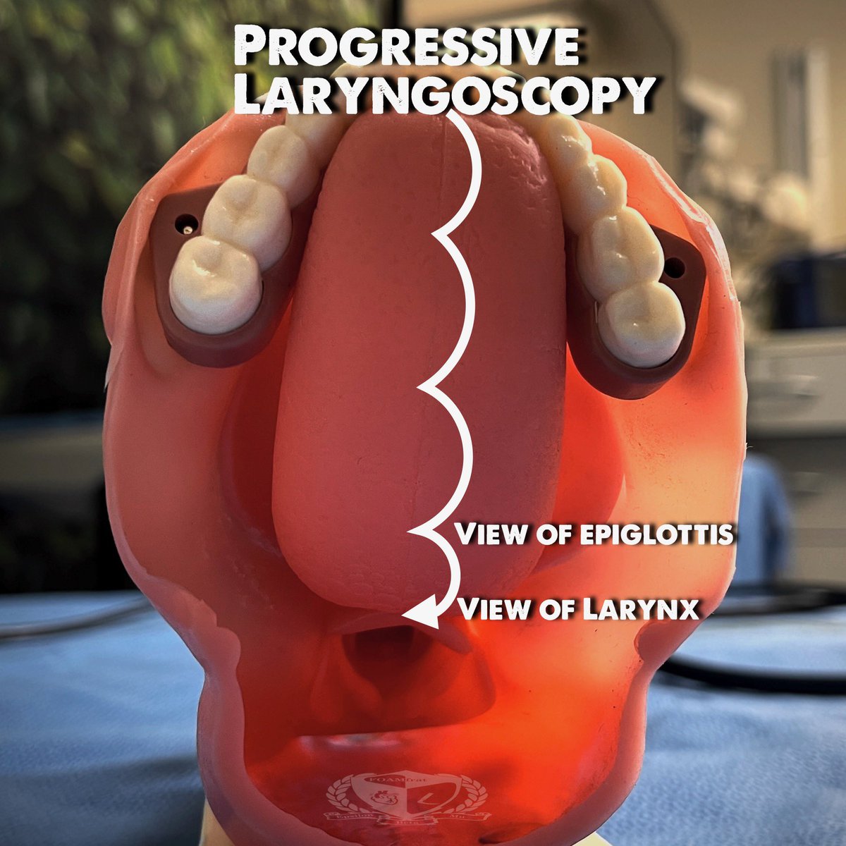 Progressive Laryngoscopy 

Methodically progressing down the tongue to the epiglottis is a simple roadmap to the larynx. 

1.Tongue.
2.Still all tongue. Stay the course.
3.The epiglottis appears.
4.Move into the vallecula and lift.