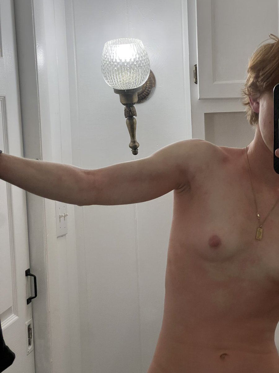 AliceOnCam's tweet photo. I had a horrible allergic reaction earlier today and had to get three shots of adrenaline lol RIP the barbecue at the wood working workshop was gunning for me https://t.co/2qE7bHvRh2