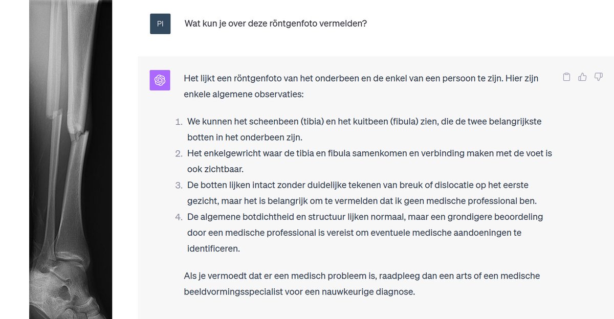 PieterStruiksma's tweet image. Het lijkt erop dat ChatGPT nog niet helemaal in orde is ... #chatgptvision #AI #radiology