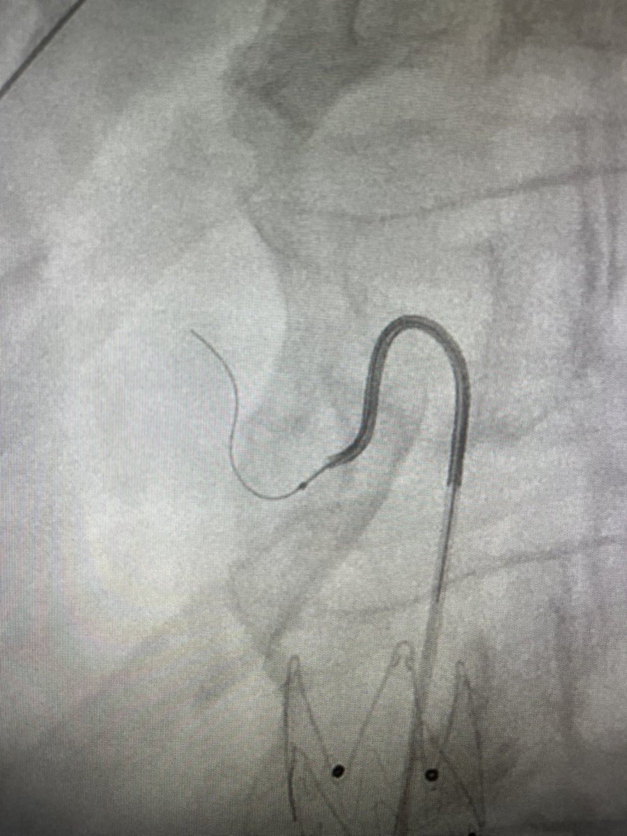 Takeoff of LGA right after celiac stenosis. J- and C-shaped microwire kept failing. Remembered preshaping Shepherd’s crook, published from IRs in Korea. 🙏🙌🙌 <a href="/dotter_IR/">The Dotter Institute</a> <a href="/DrKoethe/">Yilun Koethe, MD</a> <a href="/SIRRFS/">SIR RFS</a>
