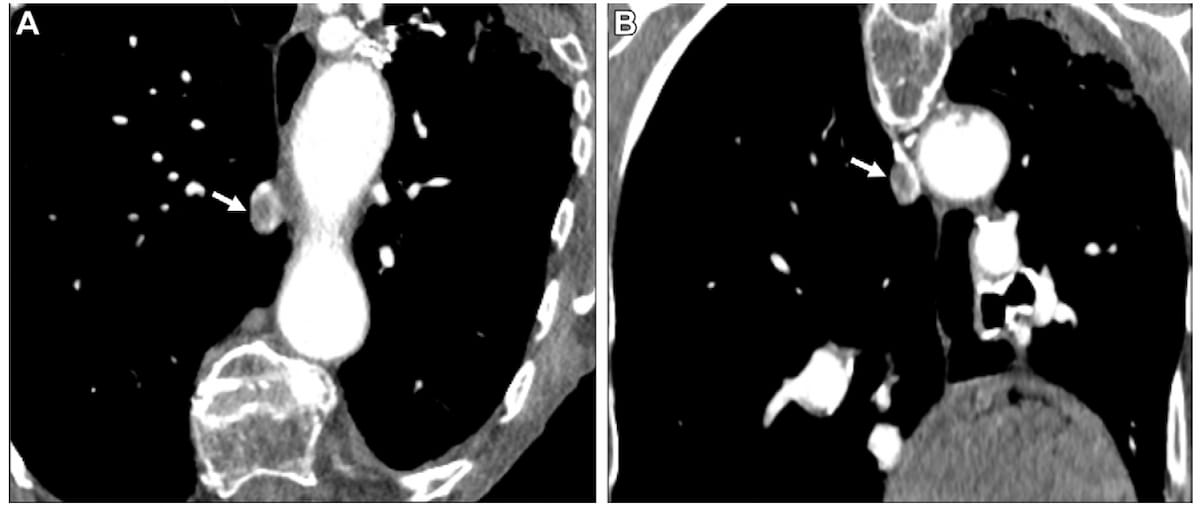 Diagnostic Imaging (@dx_imaging) on Twitter photo Study Shows Mixed Results with #AI Software for PE Detection on CTPA Scans diagnosticimaging.com/view/study-mix⦠<a href="/ACRRFS/">ACR RFS - We've Moved! Follow <a href="/RadiologyACR/">American College of Radiology</a>.</a> <a href="/ACRYPS/">ACR YPS- We've Moved! Follow @RadiologyACR.</a> @RadiologyACR <a href="/ARRS_Radiology/">ARRS</a> <a href="/RSNA/">RSNA</a> <a href="/YaleRadiology/">Yale Department of Radiology & Biomedical Imaging</a> <a href="/OSURadiology/">Ohio State Radiology</a> <a href="/BrighamRad/">Brigham and Women's Radiology</a> <a href="/DukeRadiology/">Duke Radiology</a> <a href="/JeffersonRads/">Jefferson Radiology</a> <a href="/UVARadiology/">UVA Radiology</a> #radiology #RadRes Study Shows Mixed Results with #AI Software for PE Detection on CTPA Scans diagnosticimaging.com/view/study-mix⦠<a href="/ACRRFS/">ACR RFS - We've Moved! Follow <a href="/RadiologyACR/">American College of Radiology</a>.</a> <a href="/ACRYPS/">ACR YPS- We've Moved! Follow @RadiologyACR.</a> @RadiologyACR <a href="/ARRS_Radiology/">ARRS</a> <a href="/RSNA/">RSNA</a> <a href="/YaleRadiology/">Yale Department of Radiology & Biomedical Imaging</a> <a href="/OSURadiology/">Ohio State Radiology</a> <a href="/BrighamRad/">Brigham and Women's Radiology</a> <a href="/DukeRadiology/">Duke Radiology</a> <a href="/JeffersonRads/">Jefferson Radiology</a> <a href="/UVARadiology/">UVA Radiology</a> #radiology #RadRes