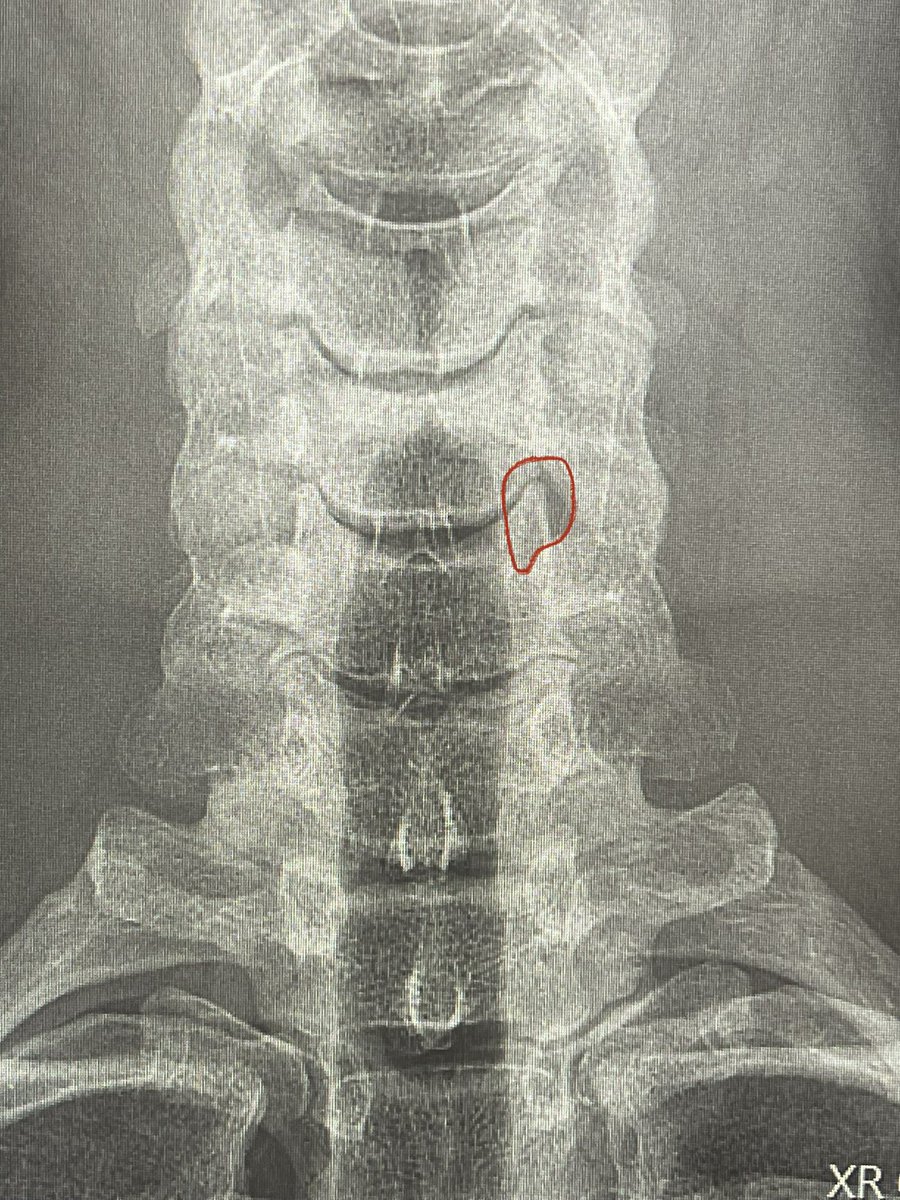 gardocki_ray's tweet photo. I don’t think we can have a discussion of motion preserving surgery in the cervical spine without including endoscopic posterior cervical foraminotomy such as this one at 3mo post op.
#futureofspinesurgery #endoscopicspinesurgery #outpatientspinesurgery
#ESRG https://t.co/mkxBPCQ7M1