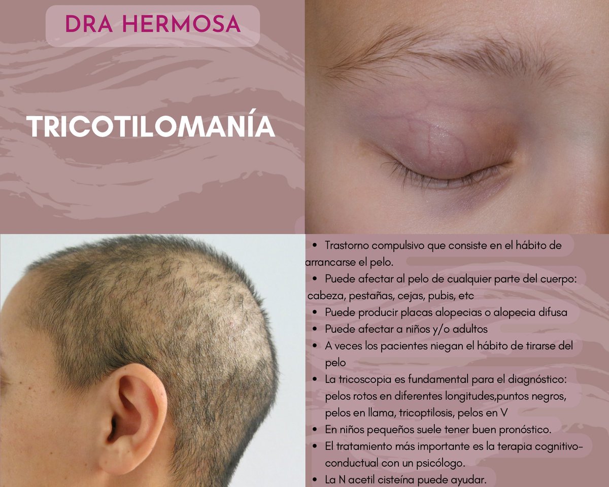 La #tricotilomania es un trastorno psiquiátrico que a menudo diagnostica el #dermatologo porque cursa con #alopecia 
#tricohrc #dermatology #trichology #dermatologia #tricologia
