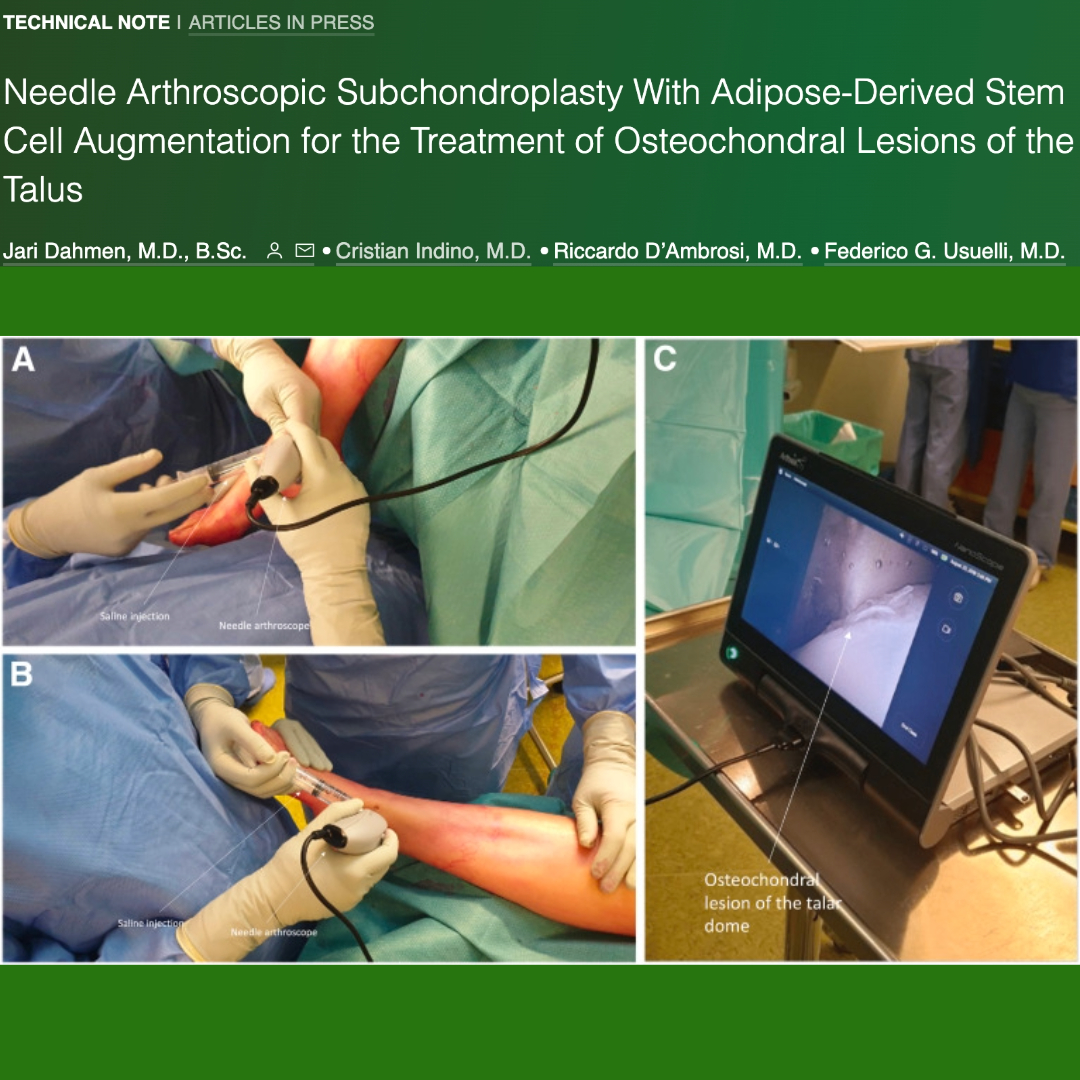 ArthroscopyJ's tweet photo. "The advantages of this procedure are the minimal invasiveness of the needle arthroscopy, the potentially improved postoperative recovery due to the decreased soft-tissue trauma and potentially improved patient experience"
https://t.co/iTxxJdddMG https://t.co/MUcsDYFQ7E