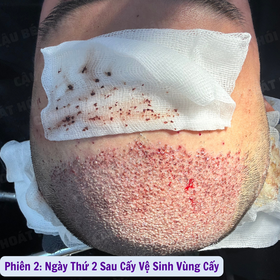 Ken76327503's tweet photo. Ngày Đầu Tiên Sau Cấy Tóc Tự Than Phiên 2 :3100 nang 
Tổng hai lần 5k1 nang  ⏭ Link Liên Hệ: https://t.co/h3BXuH7zPF  #caytoctuthan #thoát_hói_thành_công #모발이식 #hairtransplant #caytocDHI #cậu_bé_thoát_hói #chữa_hói https://t.co/fwseNSDiUo