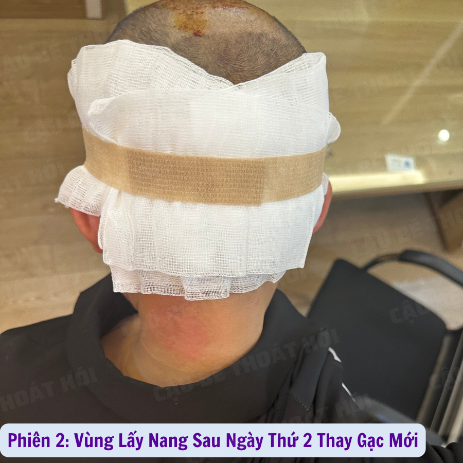 Ken76327503's tweet photo. Ngày Đầu Tiên Sau Cấy Tóc Tự Than Phiên 2 :3100 nang 
Tổng hai lần 5k1 nang  ⏭ Link Liên Hệ: https://t.co/h3BXuH7zPF  #caytoctuthan #thoát_hói_thành_công #모발이식 #hairtransplant #caytocDHI #cậu_bé_thoát_hói #chữa_hói https://t.co/fwseNSDiUo