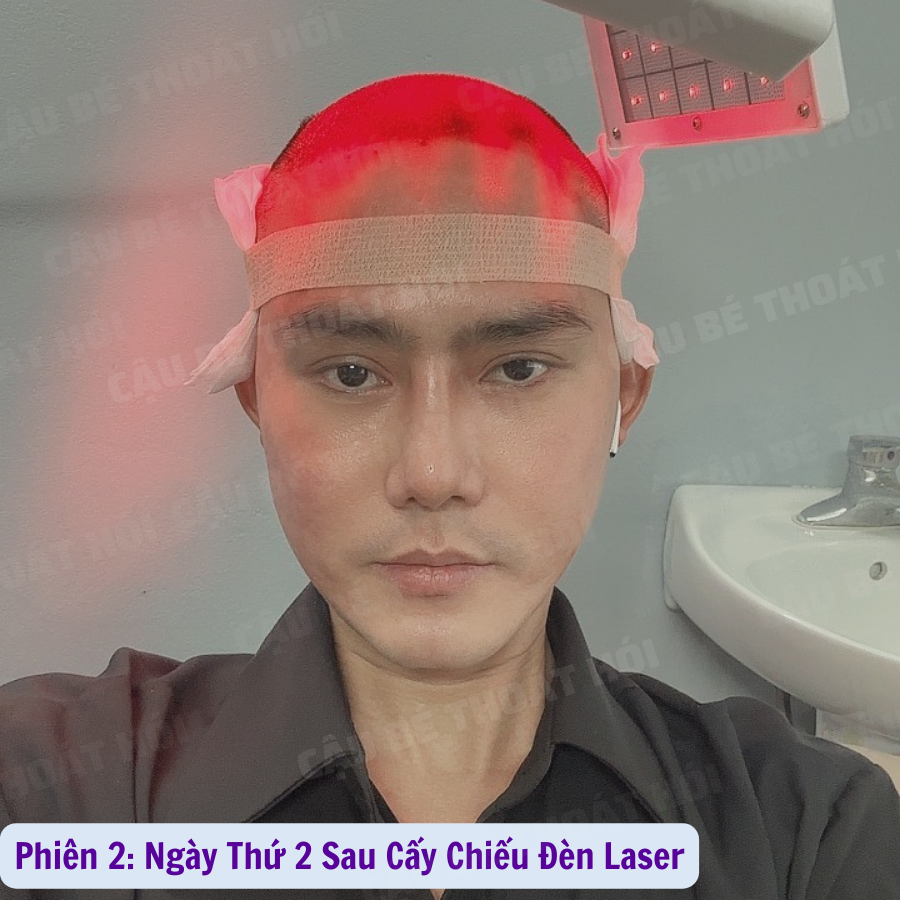 Ken76327503's tweet photo. Ngày Đầu Tiên Sau Cấy Tóc Tự Than Phiên 2 :3100 nang 
Tổng hai lần 5k1 nang  ⏭ Link Liên Hệ: https://t.co/h3BXuH7zPF  #caytoctuthan #thoát_hói_thành_công #모발이식 #hairtransplant #caytocDHI #cậu_bé_thoát_hói #chữa_hói https://t.co/fwseNSDiUo