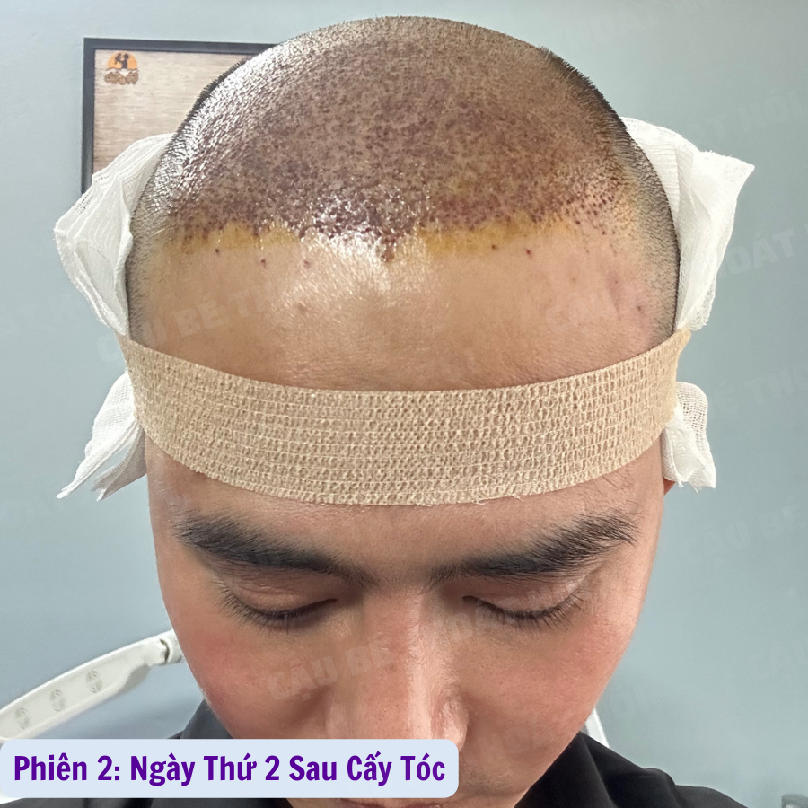 Ken76327503's tweet photo. Ngày Đầu Tiên Sau Cấy Tóc Tự Than Phiên 2 :3100 nang 
Tổng hai lần 5k1 nang  ⏭ Link Liên Hệ: https://t.co/h3BXuH7zPF  #caytoctuthan #thoát_hói_thành_công #모발이식 #hairtransplant #caytocDHI #cậu_bé_thoát_hói #chữa_hói https://t.co/fwseNSDiUo