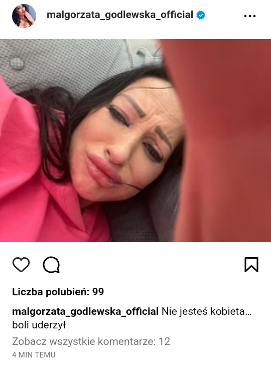 PokaOka's tweet photo. Małgorzata Godlewska dodała na instagramie zdjęcie i OPIS, które sugerują, że ktoś ją uderzył. 

Tylko jak jej można pomóc, skoro niewiadomo czy to prawda, czy kolejny post pod publikę? 

Znając życie, zaraz to usunie. https://t.co/sZplR7nj4l