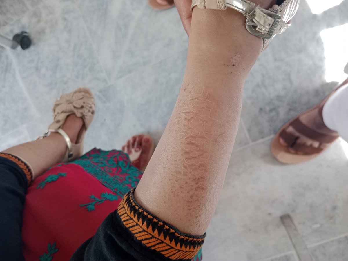 drgulfi's tweet photo. @DocSplain
3 days history of pruritis in the affected area https://t.co/dQCFYmy4Tv