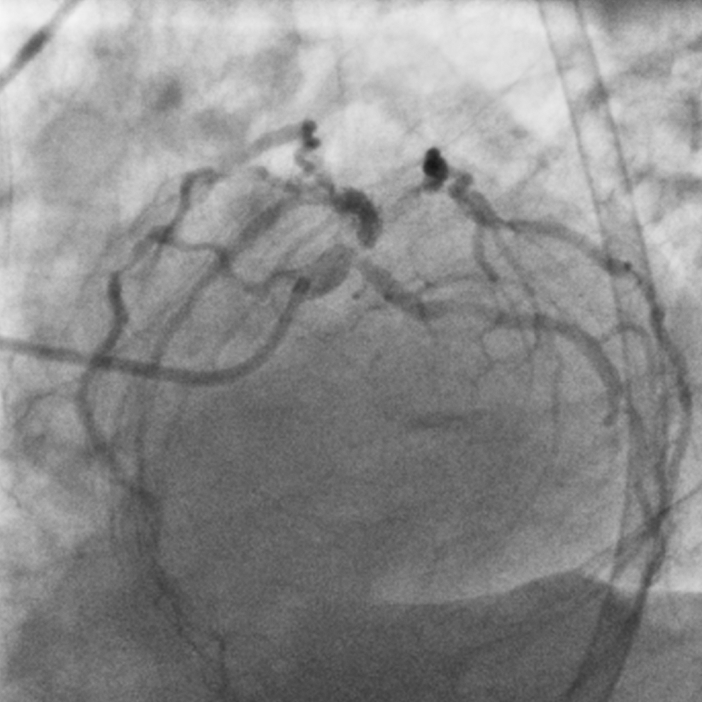 morrethound's tweet photo. 78-year-old man with kidney transplantation, previous PCIs and PAD. #NSTEMI during small bowel resection. Hb 8.9 g/dL despite RBC transfusions. LVEF 50%. CTO of RCA and OM1, calcified stenosis at LM bifurcation, LAD with ISR and multiple lesions. #SYNTAX 62. 
How would you treat? https://t.co/LLirkRY47z