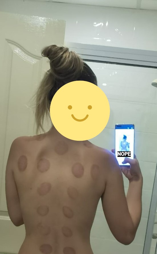 CleansedTweets's tweet photo. Propper bruising after doing that cupping thing 😂 #havenocluewhatiamdoing https://t.co/bwe1g6PsI2