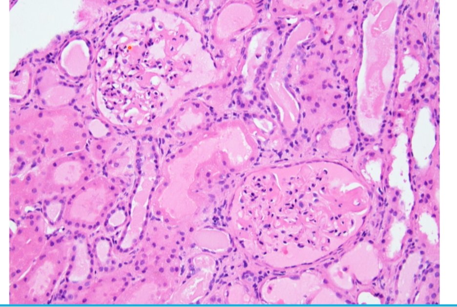 anueru432's tweet photo. Day 2 started off strong with #renalpath #transplantpath from Dr. Hassler of @templepathology
Look out for:
👍artifactual changes
👍fibrosis
👍inflammation
👍tubular atrophy and necrosis
👍number of glomeruli
👍vascular changes
#CAP23 https://t.co/5XSY9WwDL7