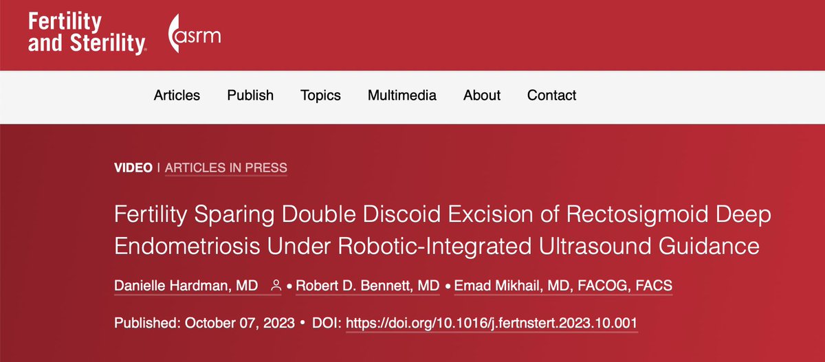 Emad Mikhail (@mikhail_migs) on Twitter photo So excited to get our newest publication <a href="/FertStert/">Fertility Sterility</a> <a href="/ASRM_org/">ASRM</a> Deep #endometriosis Surgery <a href="/USFObGyn/">USFObGynResidency</a> Thrilled to present the Double #Discoid technique fertstert.org/article/S0015-… #SoMe4Endometriosis So excited to get our newest publication <a href="/FertStert/">Fertility Sterility</a> <a href="/ASRM_org/">ASRM</a> Deep #endometriosis Surgery <a href="/USFObGyn/">USFObGynResidency</a> Thrilled to present the Double #Discoid technique fertstert.org/article/S0015-… #SoMe4Endometriosis