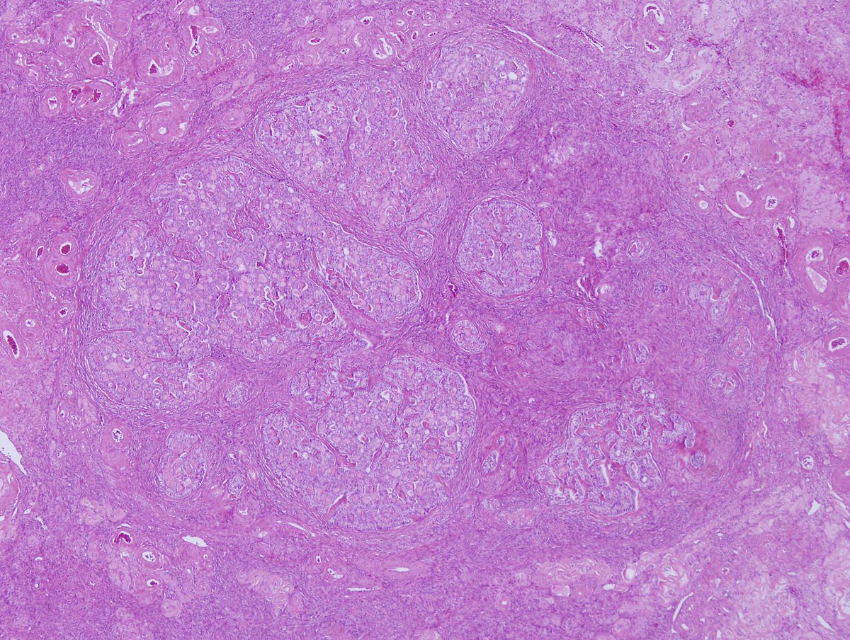 MehmetKefeli's tweet photo. Sex Cord Tumor with Annular Tubules (SCTAT) associated with Peutz-Jeghers Syndrome
📌36% with PJS (Bilateral, smaller, multifocal)
🔬Sharply delineated ring-shaped tubules surround dense hyaline material
🔬Double Row: Nuclei located both periphery and centrally 
🧬SKT11 mutation https://t.co/LBk7IsWZKw