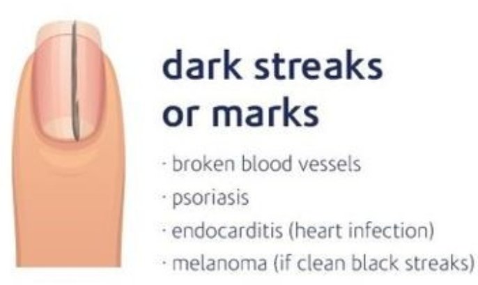 doctorsugar's tweet photo. 6.) Dark streaks or marks: Broken blood vessels, Psoriasis, endocarditis (heart infection), Melanoma (if clean black streaks) https://t.co/6GT4mxL6oK
