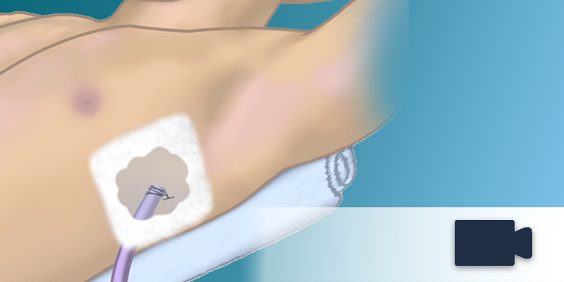 OPENPediatrics's tweet photo. This video by Dr. Chris Weldon has more than 860K views. Watch as he gives an in-depth demonstration of properly placing a thoracostomy tube. https://t.co/Zzs8VvhicT #MedEd #PedsICU https://t.co/ePukwECVGW
