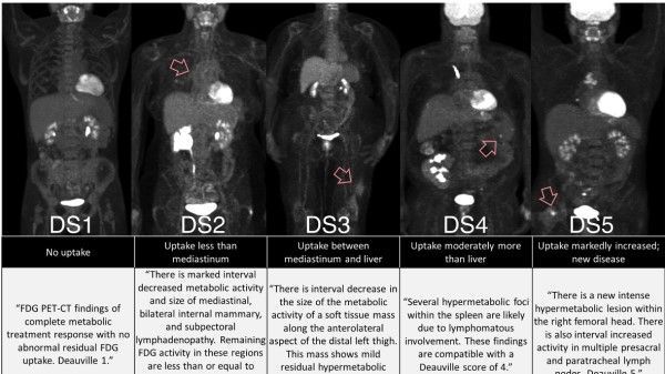 Radiology_AI's tweet photo. Adaptation of language models to the #NuclearMedicine domain improved their performance in predicting Deauville scores in PET/CT reports https://t.co/oYXRICTD7r @TyBradshaw11 @JunjieHu12 #BioBERT #ReBERTa #ML https://t.co/lxLnQRWDWJ