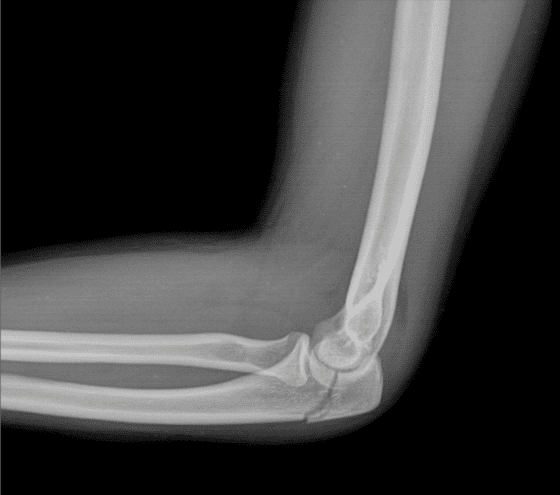 What angle would you cast this fracture in?

90° or 45°?

Genuinely curious...

#ortho #emergencymed

@InvictaOrtho @traumaticum @FractureDoc @generalorthomd @StressHoop @NaanDerthaal @RCEMdean @DrLindaDykes @EmergMedDr @First10EM @srrezaie @EMSwami