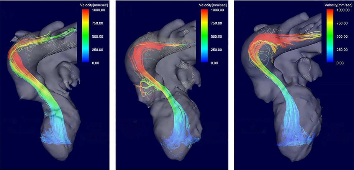 NEW PUBLICATION 📜4D Flow Cardiac MRI to Assess Alcohol Septal Ablation for Hypertrophic Obstructive Cardiomyopathy 🔹4D flow #WhyCMR assesses success of alcohol septal ablation for septal wall reduction in HOCM with multiple obstructions ⛓️doi.org/10.1148/ryct.2…