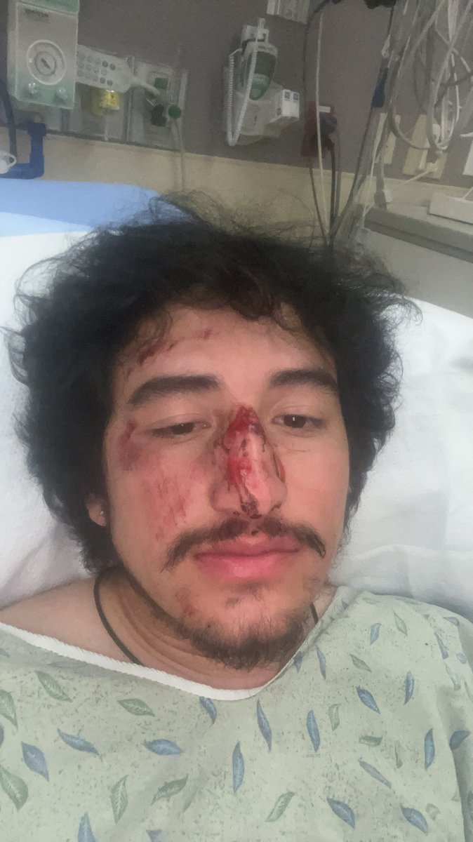 Prodsumdaze's tweet photo. Got my nose broken this weekend for jumping in the middle of a domestic violence dispute https://t.co/T43ems7FUx