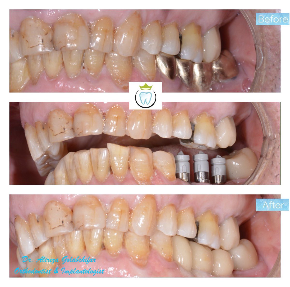 dentistry_king's tweet photo. Replacement of missing premolar &amp; molars using dental implants and in-office CEREC CAD/CAM e.max crowns.

#implant #immediateimplant #cosmeticdentistry #empresswalkdental #kingwestdentistry #dental
#dentist #smile #Torontoimplants 
#smile #cosmeticdentistry #smiletransformation https://t.co/PDBrkSGo8j