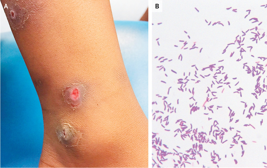 5-y-o ♀️ after a trip to Sierra Leone: pruritic lesions on legs, and an area ulcerated and bleeding (A). 

Gram’s staining: B. 
🧫: Staphylococcus aureus, group A streptococcus, & Corynebacterium diphtheriae.
1/2  

DOI: 10.1056/NEJMicm1701825
#Pediatrics #IDtwitter #IDfellowship