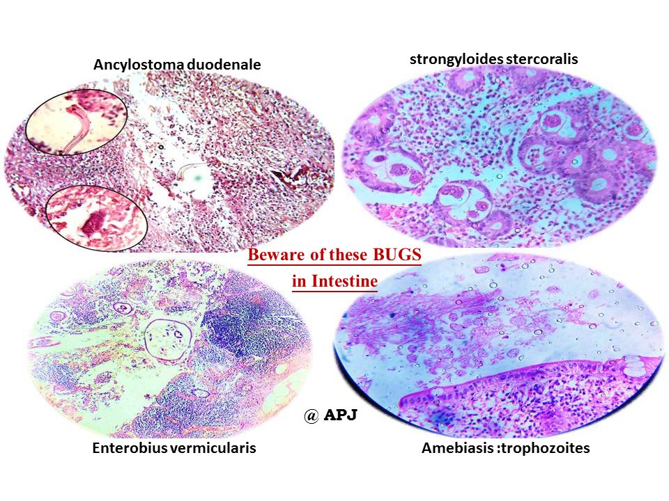 anitajawalgi's tweet photo. Bugs bothering bowel.
Key
#KAPCON2023 #KAPCONPathX2023
#PathTwitter
#pathology https://t.co/3Dd3kLNmO5