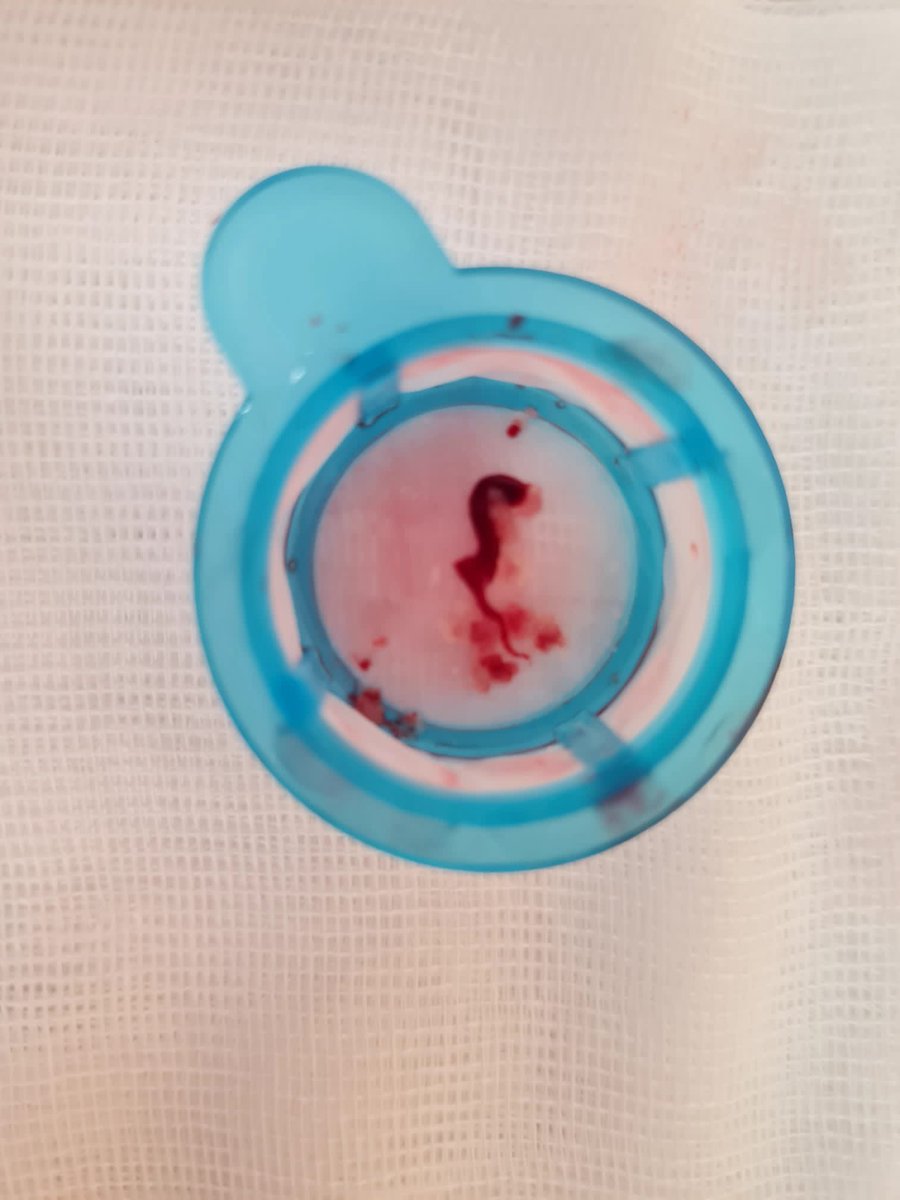 Arianit_P's tweet photo. Here we go! To aspirate or not to aspirate! 
#radialfirst #CardioTwitter @VRubesch @vlacho13 @MohammadAlMawe3 @KardiologieHH @klinikumlippe https://t.co/MbyIYitj94