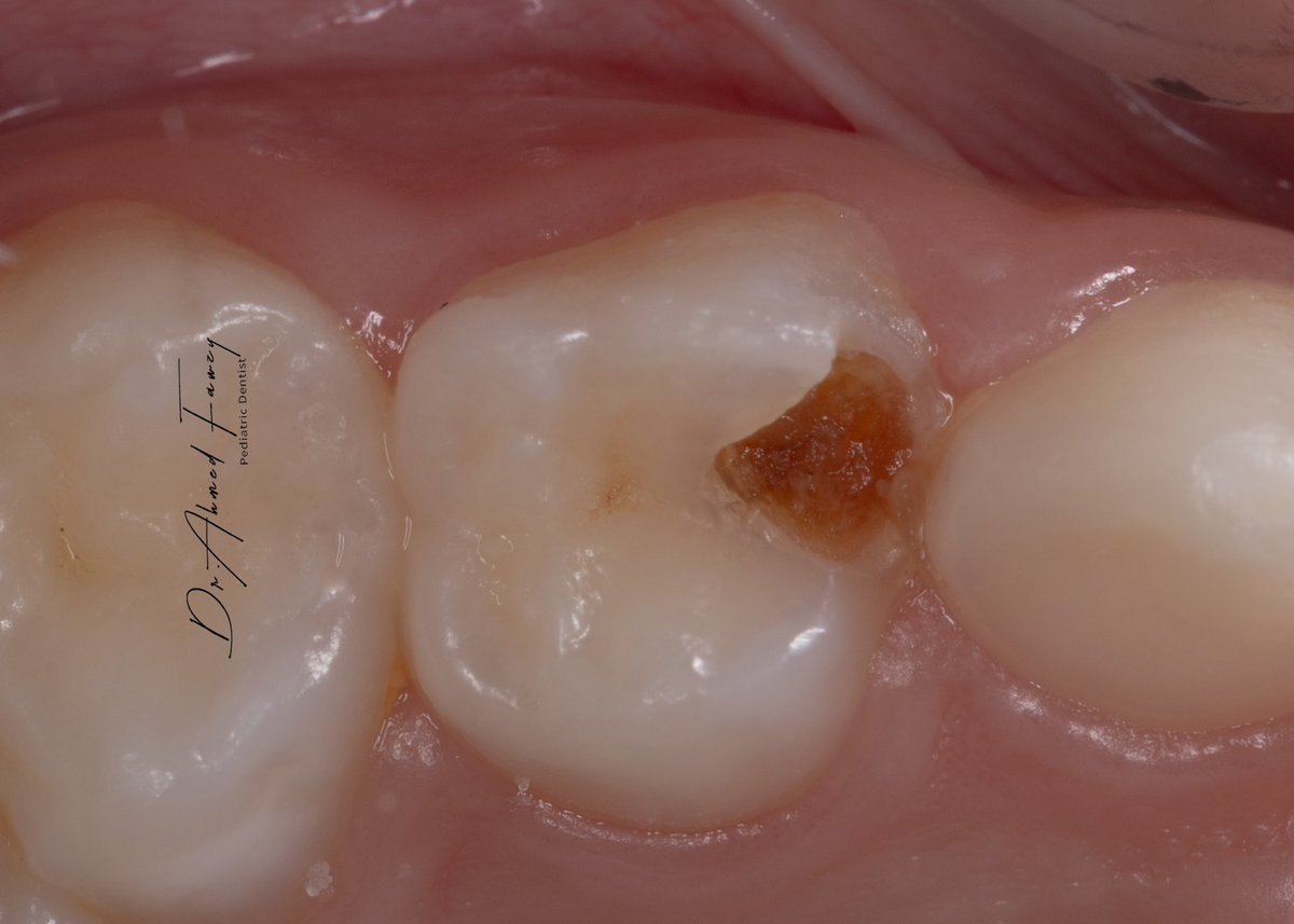 drfawzydentist's tweet photo. The new #BioFlx pediatric Crowns in Service #pediatric_dentistry https://t.co/QATgw043RE