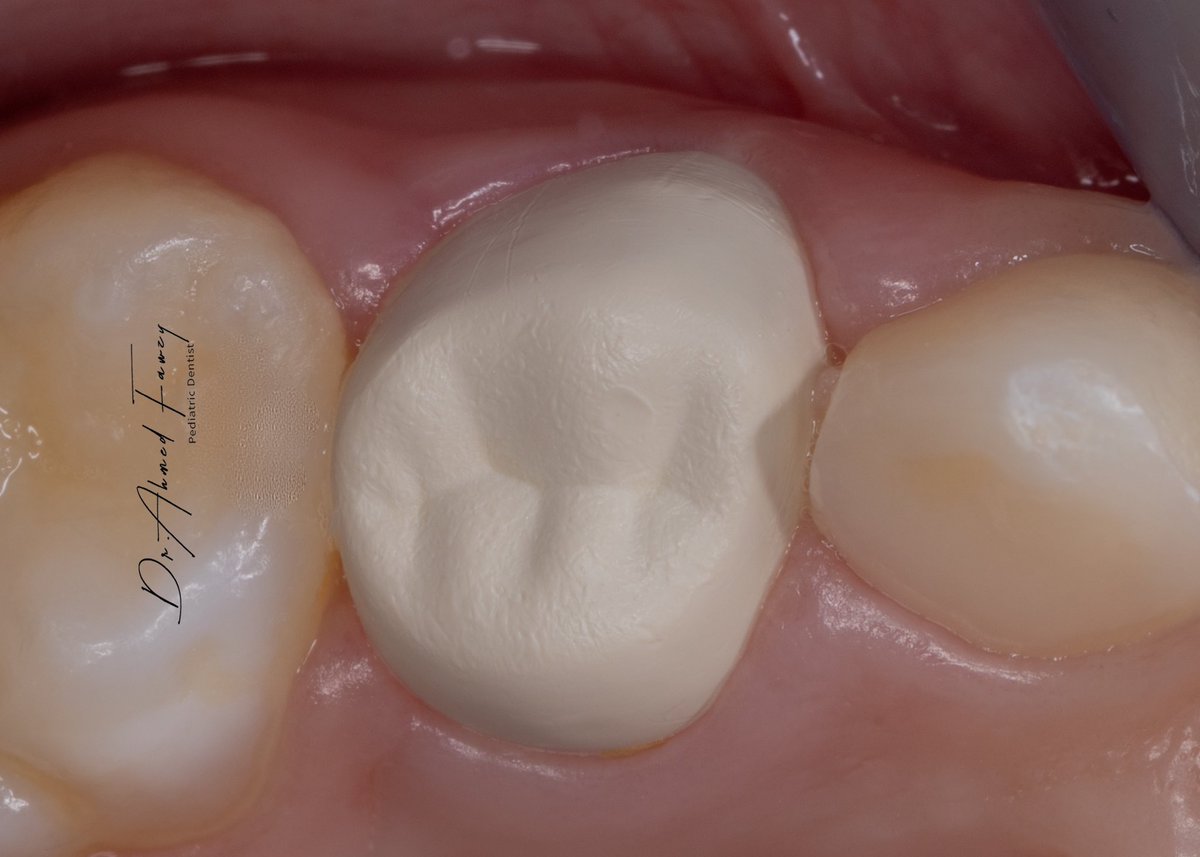 drfawzydentist's tweet photo. The new #BioFlx pediatric Crowns in Service #pediatric_dentistry https://t.co/QATgw043RE