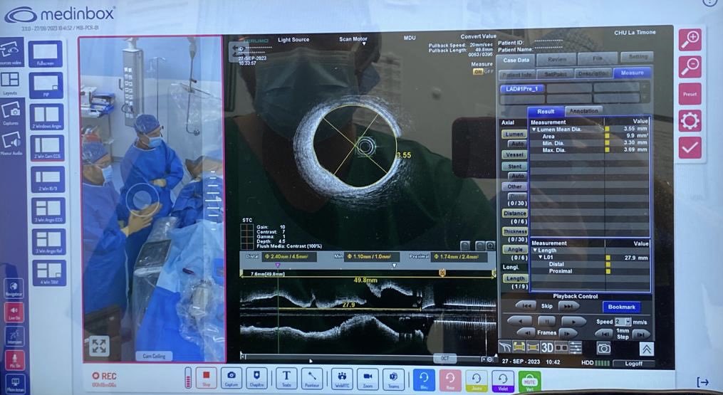 DrThomasCuisset (@cuissetdr) on Twitter photo Préparation High-tech 2024 avec enregistrement ce jour des cas « Angioplastie TCG guidée par Imagerie » pour Symposium Terumo <a href="/deharo_pierre/">pierredeharo</a> <a href="/aphm_actu/">AP-HM - Hôpitaux Universitaires de Marseille</a> <a href="/HighCardio/">High Tech - Cardiologie Interventionelle</a> <a href="/PCRonline/">PCRonline 🫀</a> <a href="/terumo_jp/">テルモ株式会社</a> Préparation High-tech 2024 avec enregistrement ce jour des cas « Angioplastie TCG guidée par Imagerie » pour Symposium Terumo <a href="/deharo_pierre/">pierredeharo</a> <a href="/aphm_actu/">AP-HM - Hôpitaux Universitaires de Marseille</a> <a href="/HighCardio/">High Tech - Cardiologie Interventionelle</a> <a href="/PCRonline/">PCRonline 🫀</a> <a href="/terumo_jp/">テルモ株式会社</a>
