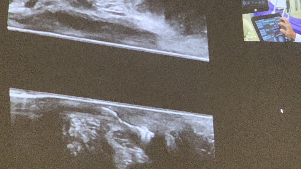 luciacolorectal's tweet photo. Beautiful fistula imagings by Dr Santoro during the #EAUS course #analfistula #ESCP2023 https://t.co/oSIQtnNm80