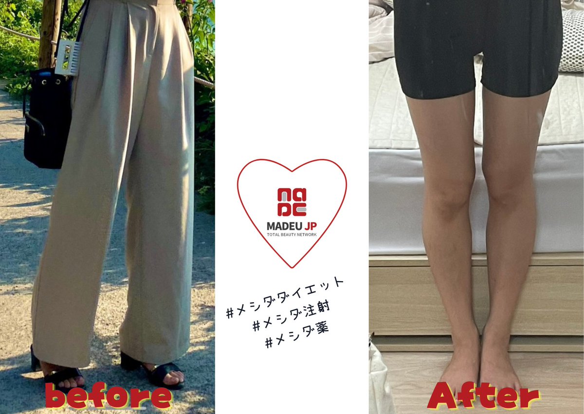 madeujp's tweet photo. 📸メイドユーお客様レビューフォト
メシダ注射💉&メシダ薬💊
1週間後のお客様経過です。
メイドユーでメシダ注射、お家ではメシダ薬を一緒に頑張っていただくことで相乗効果が◎
▼ご予約
https://t.co/oMX51kmIJt
#メイドユー #ダイエット #ダイエット薬 #韓国ダイエット #MADEU #ダイエット注射 https://t.co/nAY20I6hoZ