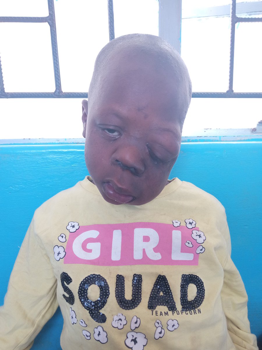 This is Shammah Kapipi Aged 8 years from Nyanga who was diagnosed with Orbital Tumour in 2019. She is suppose to go for an eye operation but parents are facing financial difficulties. For assistance contact Clara Fombe (mother) on 0715938008 / 0773844529