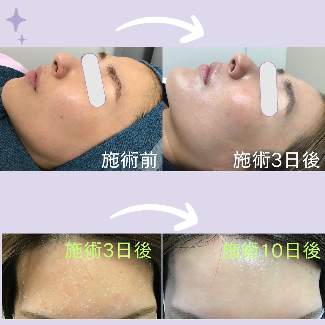 🆕10月キャンペーン🆕 美白・シミ・肝斑などに効果のあるトラネック