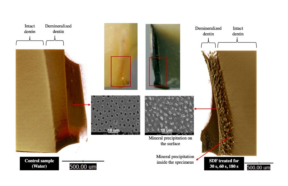 DentistryJ's tweet image. Effects of  Different Application Times of Silver Diamine Fluoride on Mineral  Precipitation in Demineralized #Dentin
@thammasat_uni
mdpi.com/2304-6767/9/6/…
#dentalcaries #demineralization #remineralization #mineraldensity
@MDPIOpenAccess @MediPharma_MDPI @DentistryJ