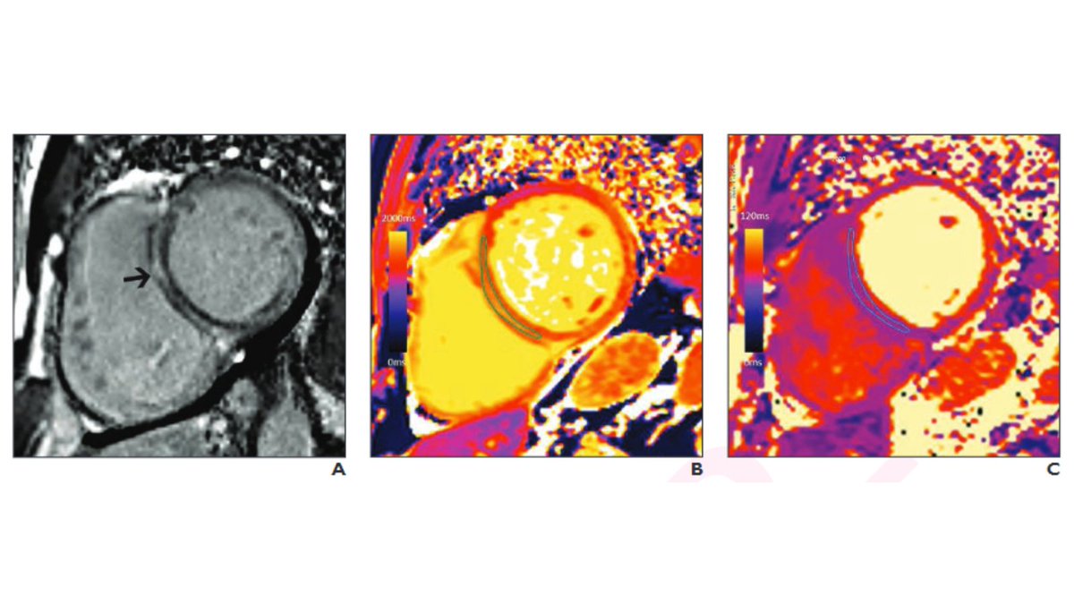 arosenkrantzmd's tweet photo. New @AJR_Radiology Accepted Manuscript:

"Imaging of Cardiac Fibrosis: An Update, From the AJR Special Series on Imaging of Fibrosis"

By Drs @GauriKarur, Rajiah, &amp; team

https://t.co/TTaHdZiXOv https://t.co/Ojy9lrB9vA