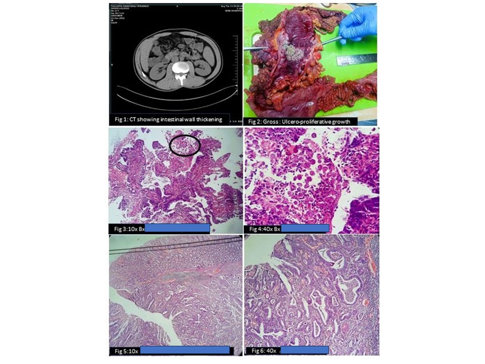 #KAPCON2023 #KAPCONPathX2023
#PathTwitter 
#Pathology 
sharing 2 cases, both GIT 
Be aware of dual lesions 
I wonder which lesion came first similar situation like 'egg or chicken first ' 
Identify the dual lesions 
Enjoy Xing and reXing