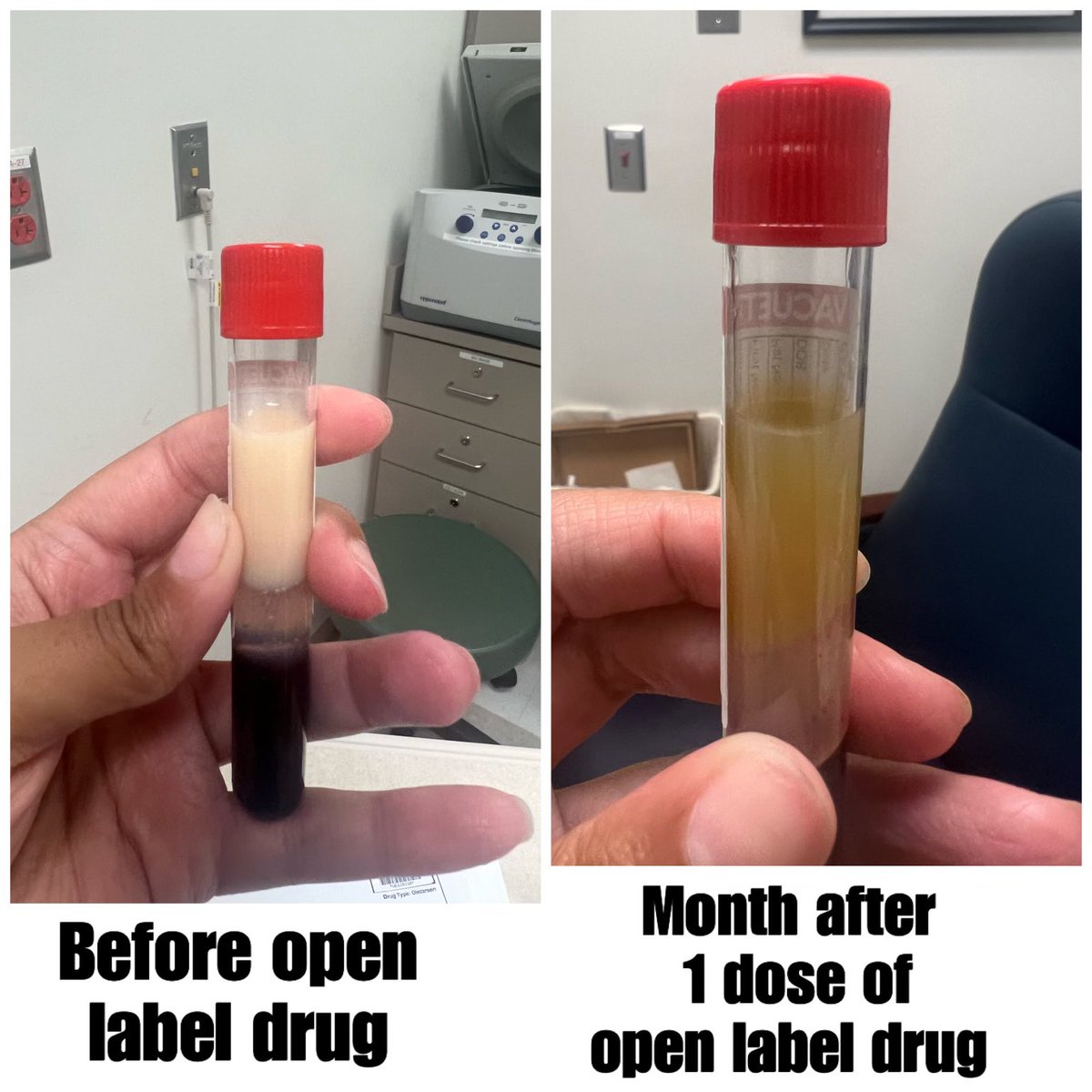 Novel molecules that can ultimately be produced at low cost will transform CV risk.  The LeBauer-Brodie Center will help drive the revolution
#Ionis #ACC #ConeHealth #Lipids
