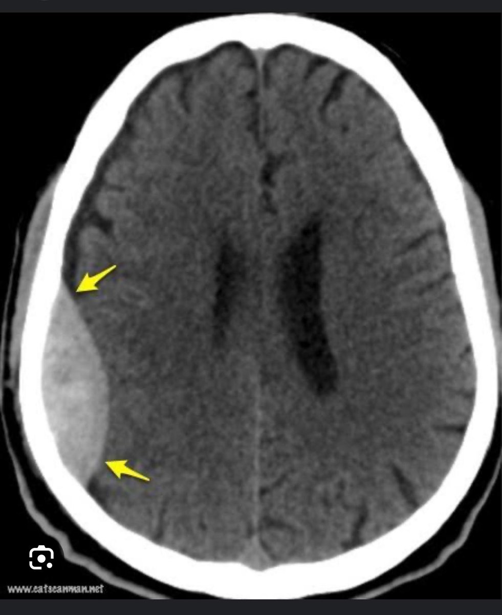Caso con imagen:

Dx : hematoma epidural
Origen sangrado: art meningea 
Sacarle glasgow